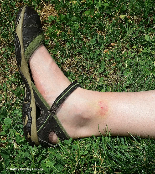 Even after five days, the bites are still visible. (Photo by Kathy Keatley Garvey)