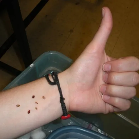 The arm of Danielle Wishon and her bedbugs, feeding.